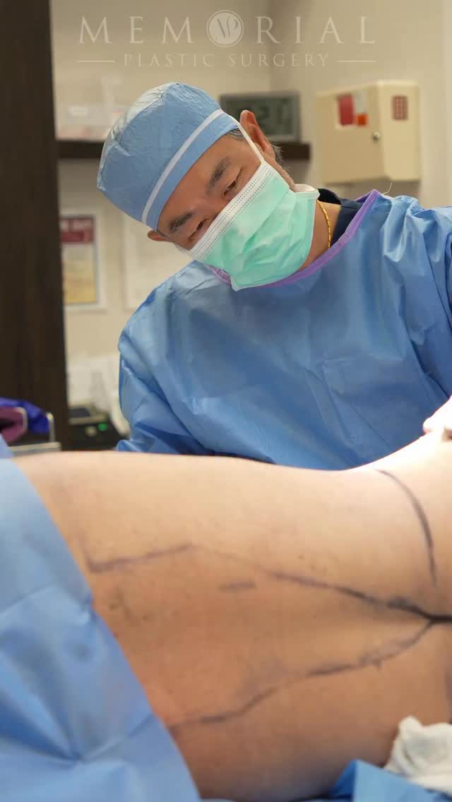 Restoring balance after motherhood — thoughtfully and intentionally 🤩
Procedure: Lipo 360, Breast Lift + Abdominoplasty
(Pre-Sx Wt: 167 lbs Ht: 5’4 BMI: 28.7)
📍 @memorialplasticsurgery | #Houston