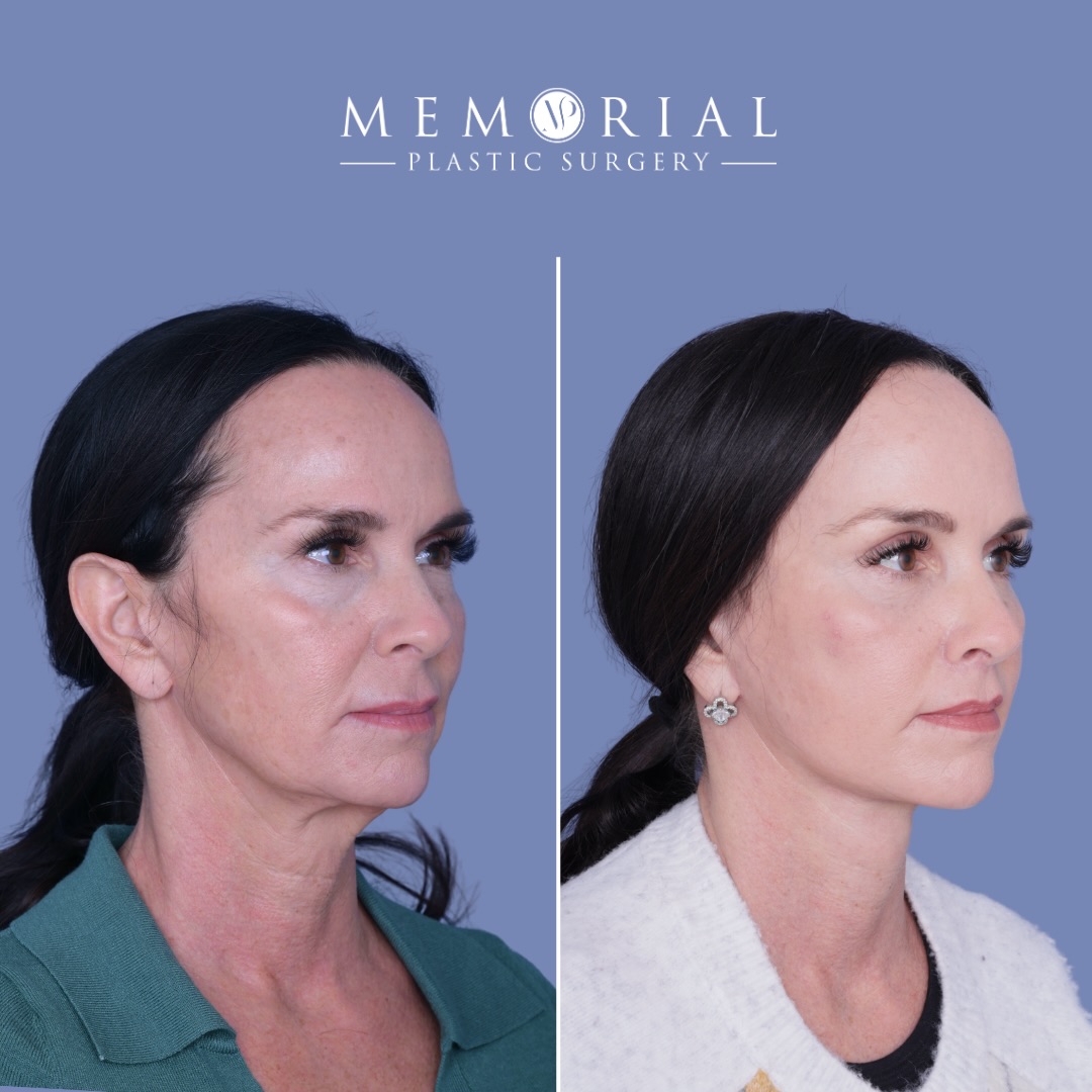 Just over 2 months out from a comprehensive facial rejuvenation, but even at 2 weeks she was showered with compliments from all her mom friends 🙌🏻
This wonderful patient had a prior isolated neck lift two years ago. She still felt a little laxity there, and this is a great example of how lifting the face also lifts the neck. Achieving that harmony is one of a million reasons we typically like to combine a deep plane facelift with a deep neck lift.
Even this early on in the course, the structural changes are already doing their job. The brow is lifted, the lower lids are smoother, and the jawline and neck have that contour back.
This is what happens when a thoughtful, tailored plan meets precise execution to rejuvenate the entire face while still looking like yourself.
Procedures performed:
🔹 Deep plane facelift
🔹 Revision neck lift with gland contouring
🔹 Endoscopic brow lift
🔹 Lower lid blepharoplasty
🔹 Facial fat grafting
🔹 Lip lift
🔹 Full-face CO₂ laser resurfacing
Thoughts, comments, questions and all below 💬