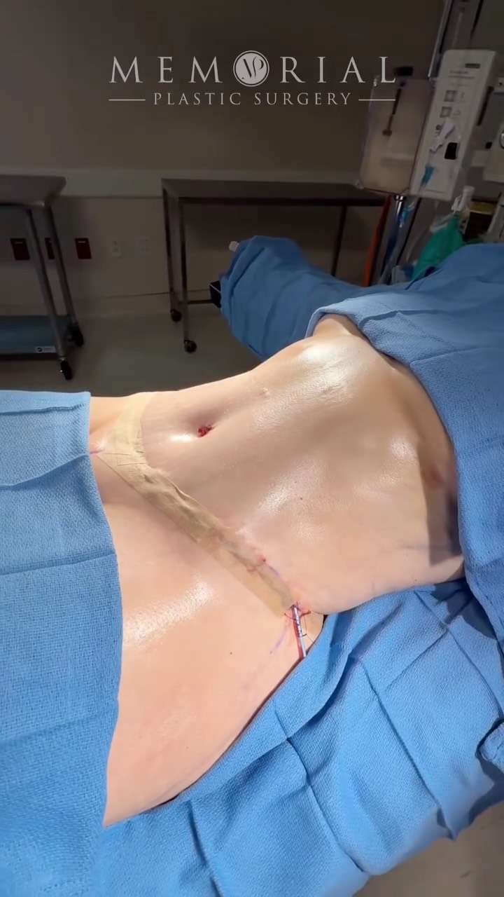 Restoring the contour after 2 pregnancies, bye bye to that extra skin! ✨
Procedure: Lipo 360 • Abdominoplasty (Standard)
(Pre Sx Wt: 150 lbs Ht: 5’5 BMI: 24.9)
📍 @memorialplasticsurgery | #Houston