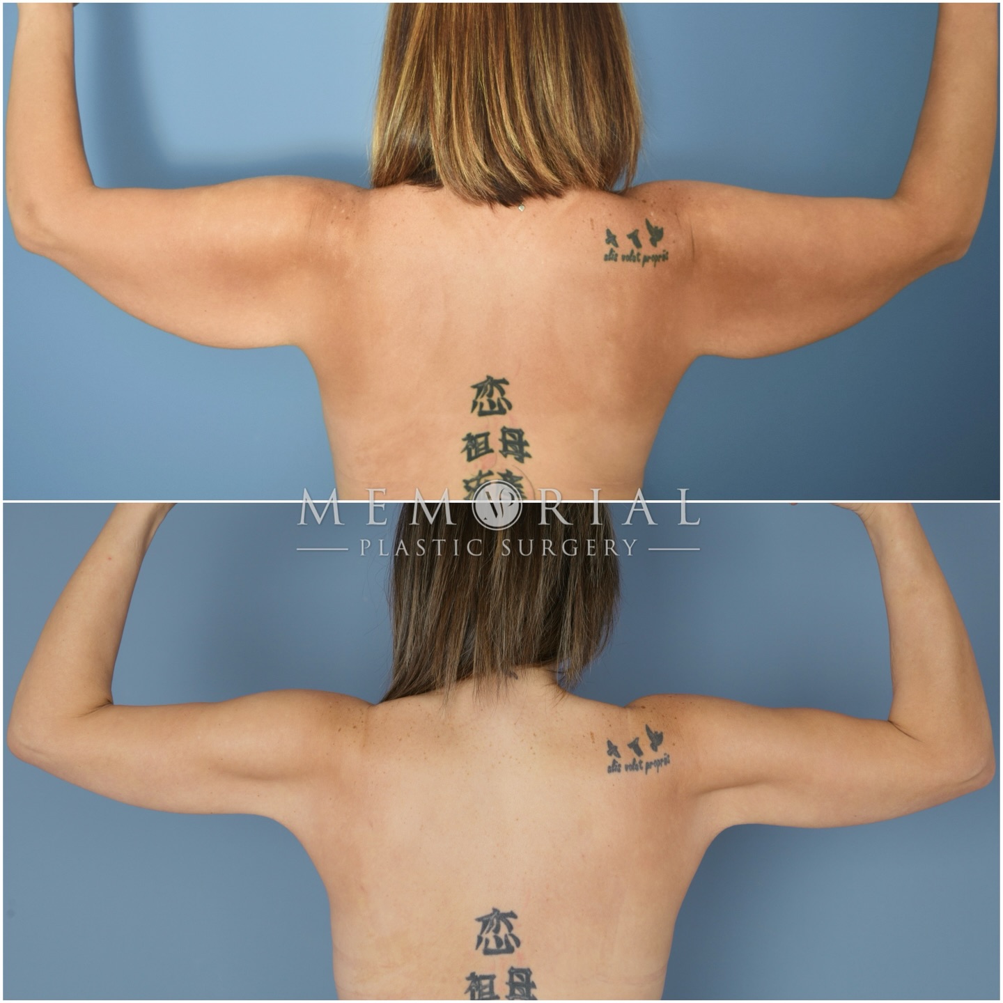 Almost 1 year post-op and my patient’s arms are looking better than ever!
My patient did an amazing job losing 170 pounds following bariatric weight loss surgery, and she was ready to contour arms.
I performed a brachioplasty (arm lift) and liposuction to the arms in order to remove the excess loose skin and thin the arms.
She has done a great job maintaining her results after surgery, which is key to the longevity of every transformation, and I am very happy for her! 🙏😊
#armlift #transformation #houstonplasticsurgeon #armcontouring @memorialplasticsurgery
