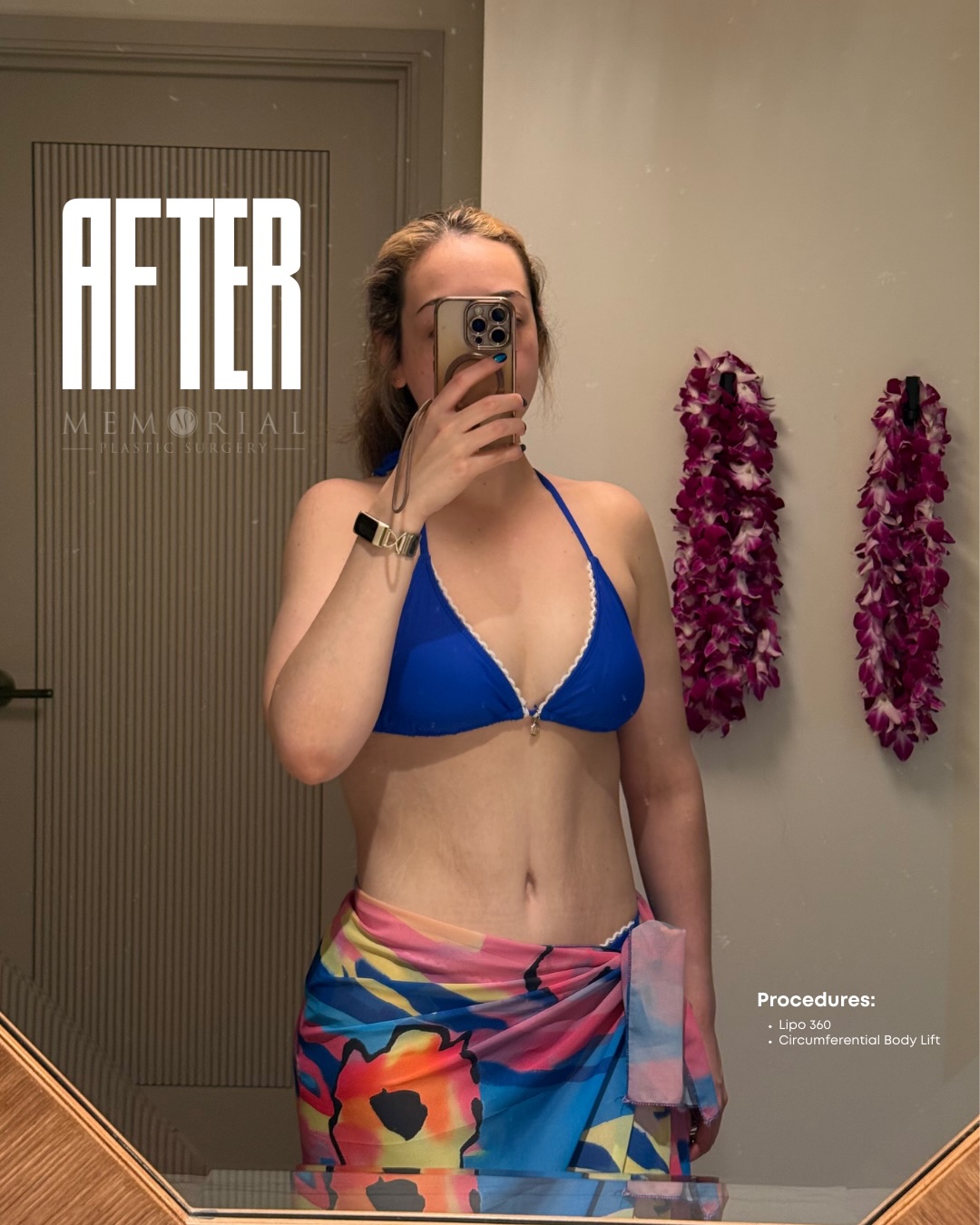 Bikini season came early! 😎
My beautiful patient did an amazing job and lost 100 lbs via diet and exercise. She came to me to complete her weight loss journey and here she is enjoying her new body at over 1 year post-op 🤩👏🏼
Procedure: Circumferential Body Lift + Lipo360 🔥
(Pre-Sx Wt: 161 lbs Ht: 5’8 BMI: 24.5)
#drvasilakis #beforeandafter #weightloss @memorialplasticsurgery