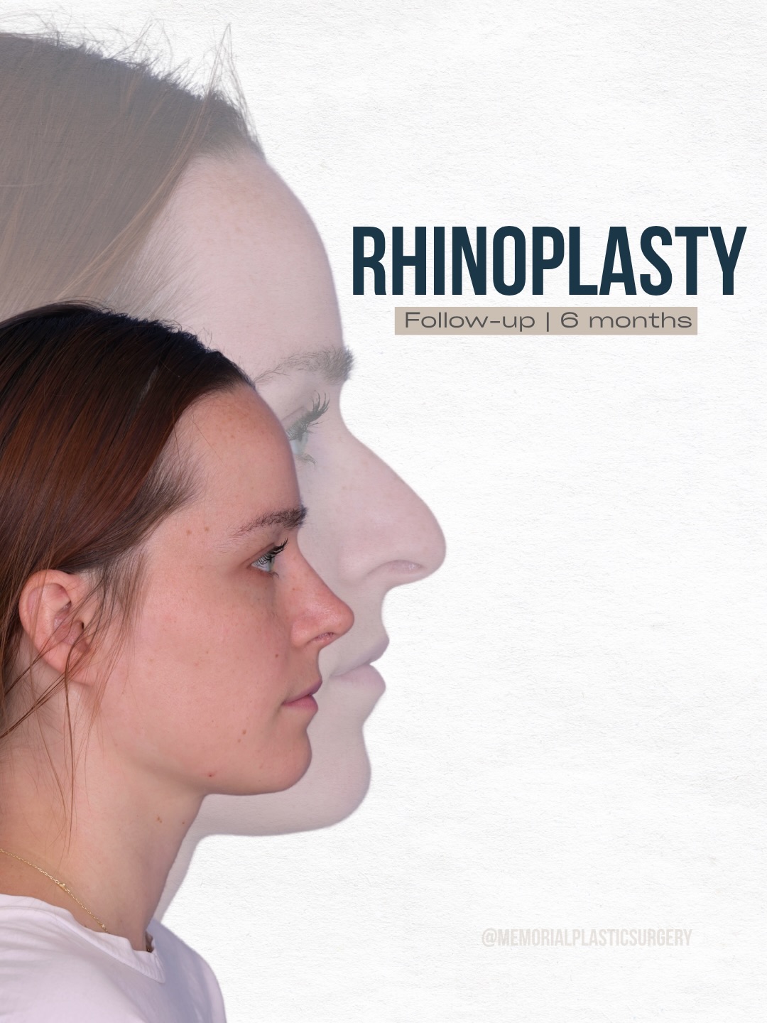 Subtle changes… loud results 📣

Six months out and everything is settling in beautifully.

A smoother dorsum, a more defined tip, and a shape that fits her face like it always belonged there.

Procedures:
🔹 Rhinoplasty
🔹 Septoplasty