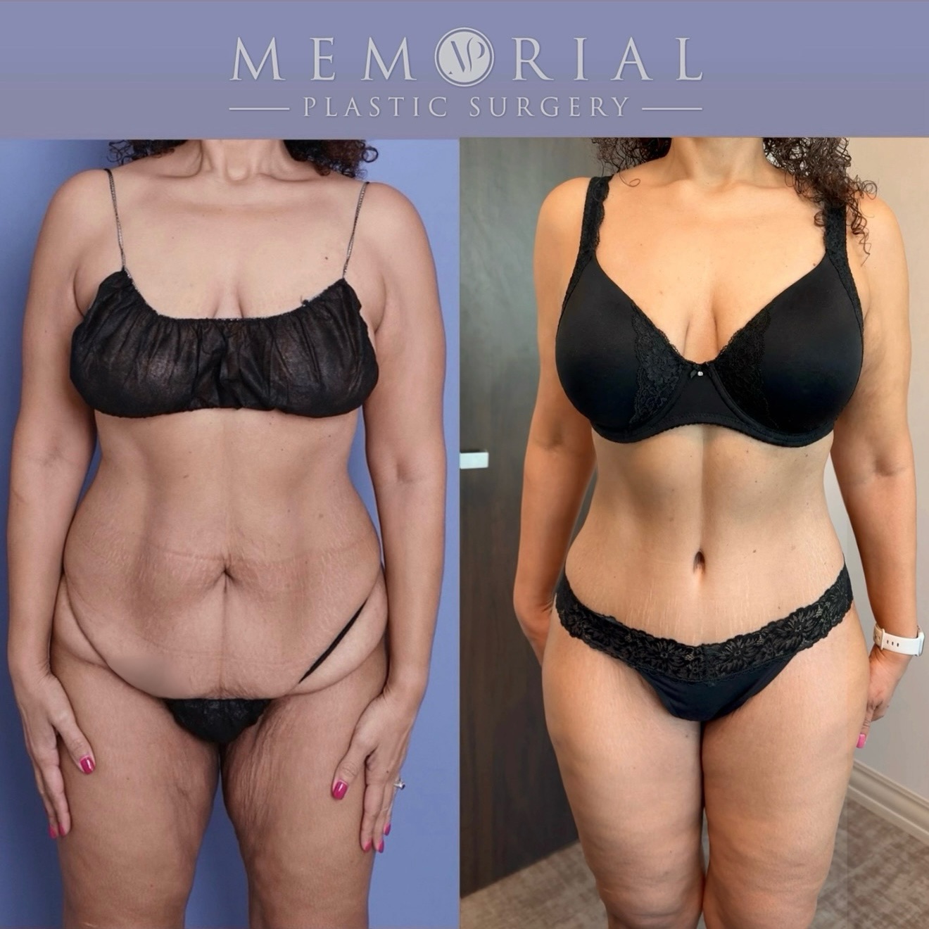 After a 100 lb weight loss following gastric sleeve surgery, her body had changed in more ways than one.

After two pregnancies, she knew she didn’t plan on having more children and was ready to focus on herself & complete her transformation.

So during her consultation, we built a plan: 
- A lower body lift to remove excess skin and restore contour through the midsection and back
- Lipo360 to shape the entire torso and enhance definition 
- Thigh lift to address loose skin and create smoother, more balanced proportions 

This is her result at 11.5 months post-op 🔥 now you can truly see the confidence that matches the work she put in to get here 🙏🏼 

📍 @memorialplasticsurgery | #Houston