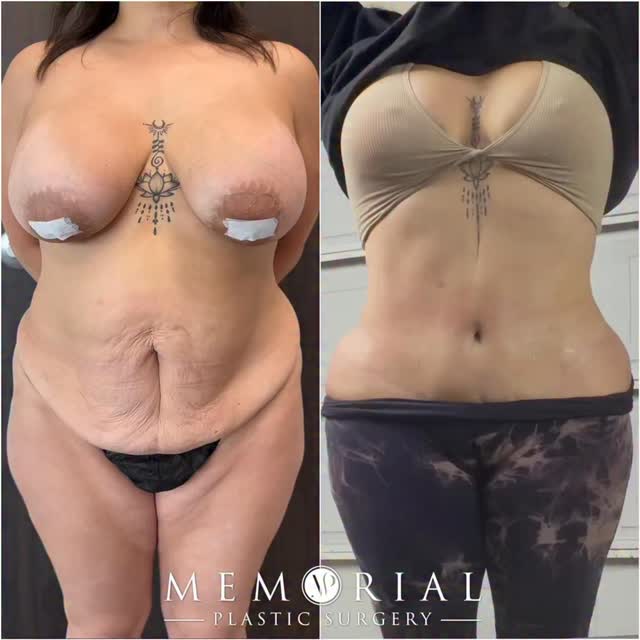 Mommy makeover results are permanent! 

The long-term goals are a tight and very thin abdomen, a natural looking belly button, and minimal scarring. 

Here, 1.5 years post-op and my beautiful patient is still looking amazing!! 🤩🔥

Procedure: Breast Lift w/ Implant Exchange, Ext. Tummy Tuck, Lipo360 & Fat Grafting to hips
(Pre-Sx Wt: 162 lbs Ht: 5’1 BMI: 30.6)

#mommymakeover #tummytuck #boobjob #houstonplasticsurgeon #transformation 

📍 @memorialplasticsurgery