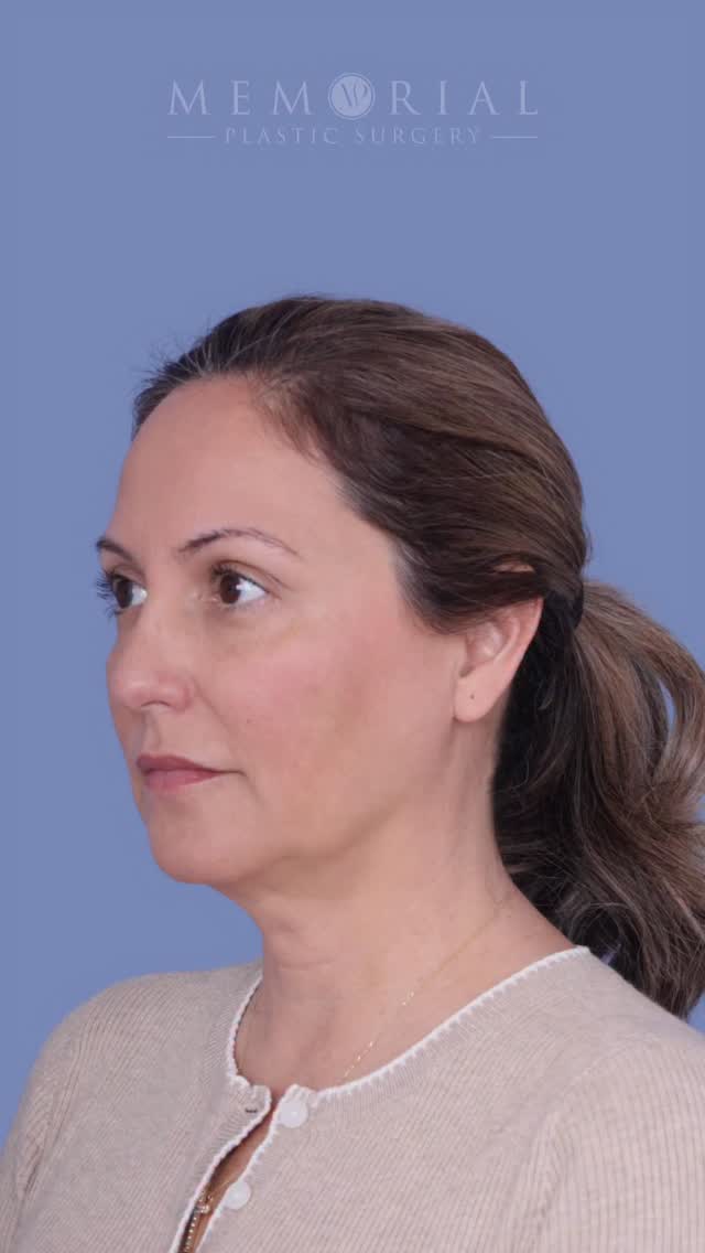 Refreshed. 🧖‍♀️

A little under two months out. Still healing and incisions are still fully settling as expected, but here are a few things I’d love to highlight that we can see this early on: 

✔️ Jawline is more refined — the deep plane release and more vertical vector of pull gets rid of that scalloping jawline and replaces it with a crisp, clean jawline.

✔️ Neckline is sharper — the blunting of the cervicomental angle (the near 90 degree angle you see in the afters) happens as soft tissue under the skin becomes lax with age. Deep neck lifts reduce that volume and create sharper contours. 

✔️ Midface volume restoration — as we age, gravity wins and volume comes down. A deep plane lift repositions the fat pads underneath as well to a more youthful state. 

Most importantly, she still looks like herself. Refreshed, but not different. 

Procedure(s):
🔹 Preservation deep plane facelift
🔹 Deep neck lift with submandibular gland reduction
🔹 Temporal brow lift

If you have a question, you know what to do 👇🏻