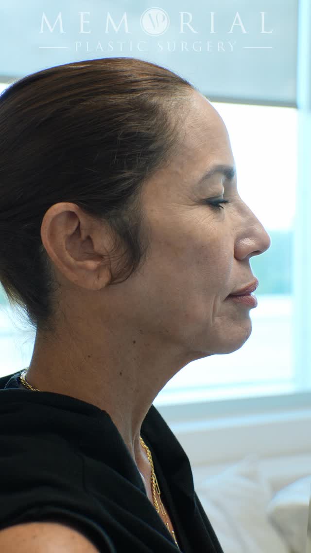 We’re all smiles here. 

Procedure(s):
🔹Preservation deep plane facelift
🔹 Deep neck lift with gland contouring
🔹 Endoscopic brow lift
🔹 Lower lid blephs
🔹 Lip lift
🔹 Fat grafting
🔹 CO2 laser resurfacing 

As always, taking questions & comments below 💬