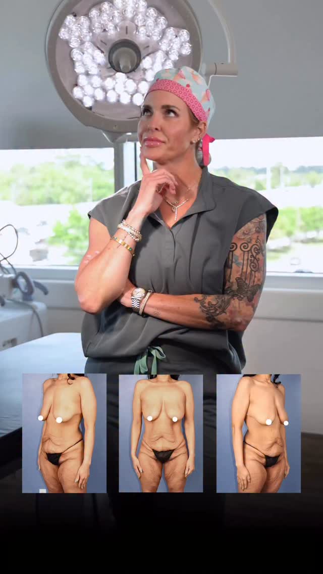 This mother of 2 came in ready for body contouring after losing 80 lbs — and we delivered ✨

Procedures: BBL | Lipo 360 | Circumferential Body Lift | Mastopexy

(Pre Sx Wt: 153 lbs Ht: 5’7 BMI: 23.9)

📍 @memorialplasticsurgery | #Houston