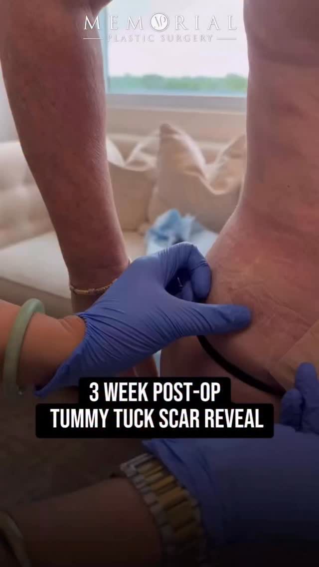 3 week Tummy Tuck scar looking great! 🔥🙌🏼🙌🏼