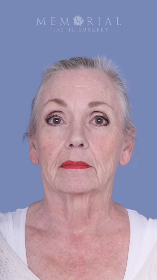 As we age, gravity pulls everything down — fat, muscle, and soft tissues. We see the jawline soften, cheeks flatten, and neck lose the sharp angles and definition that we once had. 

Deep plane facelifts aim to restore all of those to their natural, youthful habitat. By repositioning deeper structures, we recreate a younger you. The result isn’t overdone, nor does it look like “someone else.” It looks like you, but refreshed. 

And lastly, those fines lines throughout the face we see are a sign of a life well enjoyed (albeit enjoyed in the sun ☀️!), but it doesn’t mean we can’t polish them up with a little laser to put the cherry on top. 

Procedure(s):
🔹Deep plane facelift
🔹Neck lift
🔹Temporal brow lift
🔹CO2 laser resurfacing

📍 @memorialplasticsurgery | #Houston

We’re 2 months out, and — as always — taking questions & comments below 💬
