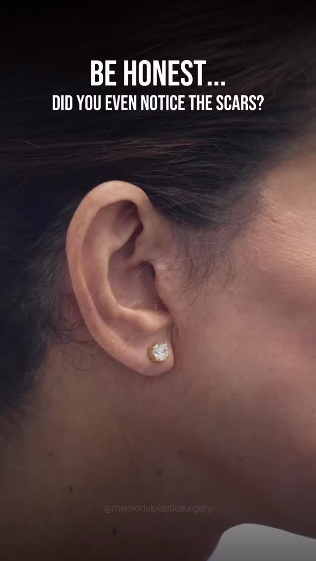 Imagine getting a deep plane facelift but not being able to put your hair up in the Houston heat? Trying to hit the tennis courts or the gym but having to wear your hair down to hide the scars? Couldn’t be her. 

Every incision is meticulously placed to stay hidden and heal as invisibly as possible. Your incisions should only be noticed by you because you know they’re there. After all, the best results whisper 🤫

📍 @memorialplasticsurgery | #Houston

As always, feel free to drop any questions or comments below 💬
