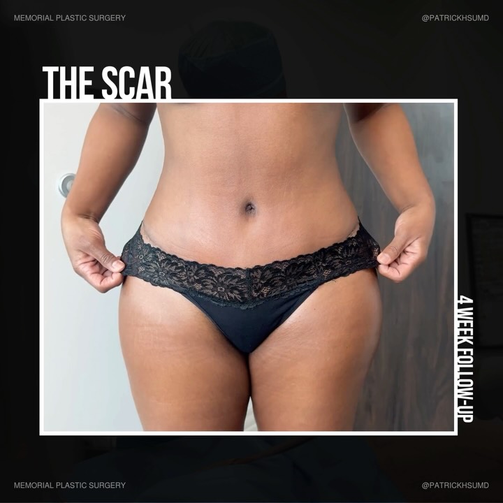 At the beginning, her biggest concern was the tummy tuck incision.

4 weeks later? It’s her smallest worry.

She’s healing beautifully, feeling incredible, and finally wearing pieces she never thought she could.

That’s what this is really about 🙌🏼

Procedures: BBL | Lipo 360 | Lipo Arms & Inner Tighs | Tummy Tuck

(Pre Sx Wt: 161 lbs Ht: 5’5 BMI: 25.5)

📍 @memorialplasticsurgery | #Houston #tummytuck #plasticsurgery #plasticsurgeon