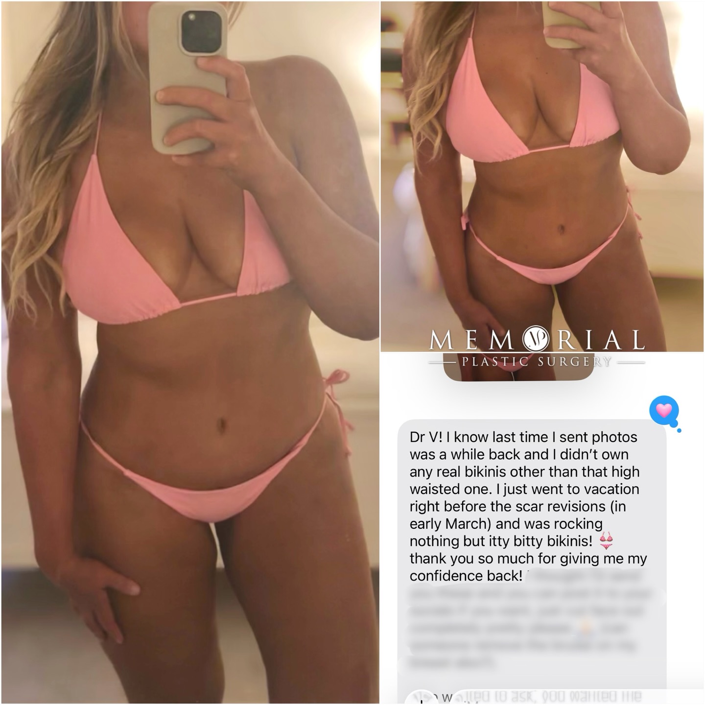 Messages like this from my patients >>> 🔥🔥

She looks amazing but most importantly FEELS amazing in her new body! 🙏🏼

Procedure: Ext. Tummy Tuck, Lipo360, Breast Lift w/ Fat Grafting to breasts & Lipo to arms
(Pre-Sx Wt: 215 lbs Ht: 5’8 BMI: 32.7)

📍 @memorialplasticsurgery | #houston

#drvasilakis #plasticsurgery #weightloss