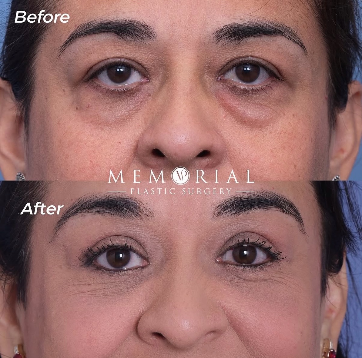 Can we take a second to appreciate what happens when heaviness turns into light again?

3 months out from a pretty comprehensive periorbital rejuvenation here.

Procedure(s):
🔹 Endoscopic brow lift
🔹 Upper lid blephs
🔹 Lower lid blephs
🔹 Fat grafting 

Same eyes, but rested and refreshed.

📍 @memorialplasticsurgery | #Houston

As always, feel free to drop any questions or comments below 💬