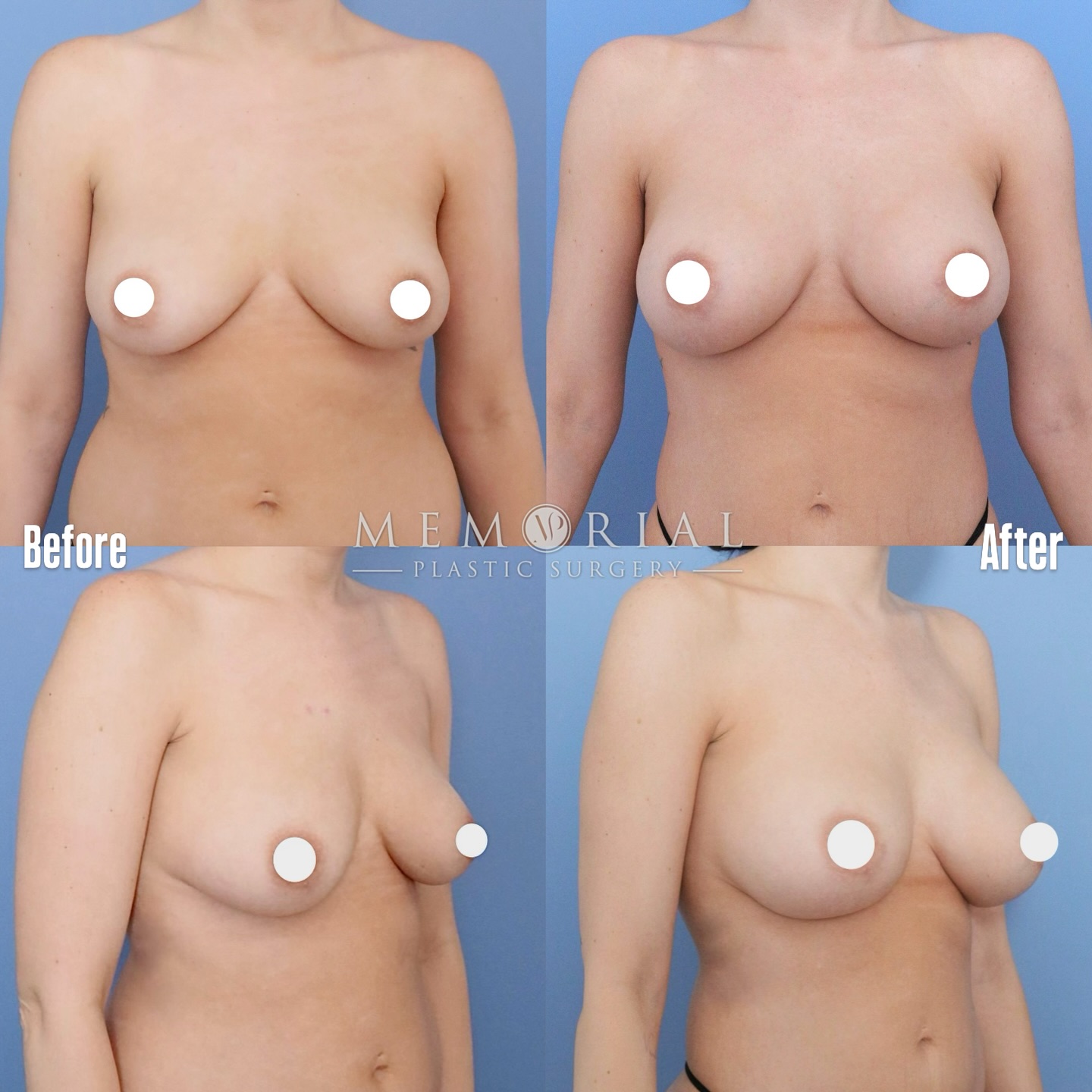 Breast Augmentation at 6 months post-op. My patient desired an elegant result, and to maintain her natural shape and form. She received 330 cc Moderate Profile Implants and also underwent fat grafting to the cleavage. The goals of this surgery were to obtain fullness in the cleavage and upper poles in order to improve the symmetry within each breast, and to maintain this balance long term.
#breastaugmentation #breastimplants #houstonplasticsurgeon #breastaugmentationhouston