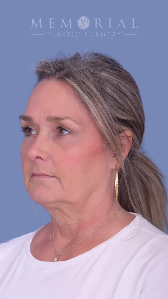 When how you feel 🤝 what you see in the mirror. 

This absolutely wonderful patient is a grandmother who keeps up with her rowdy and energetic grandchildren, but that liveliness and vitality wasn’t reflected on the outside as much. 

We are now ✌🏼 months out from a preservation deep plane facelift and deep neck lift. We really freed up the layers that had fallen with time and put them back in a much more youthful position, but you can’t discount how impactful sculpting the neck was. That neckline and jawline contour is largely a combination of sculpting fat, muscle, and little salivary glands. 

This is what happens when you combine an amazing patient, a great plan, and meticulous surgery. 

Procedure(s):
🔹 Preservation Deep Plane Facelift
🔹 Deep structural neck lift with gland contouring

As always, questions, comments, queries below. 💬