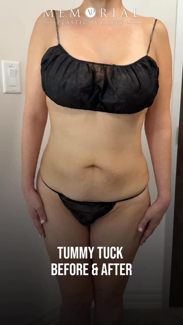 After two kids & a 40-pound weight loss, my amazing patient was ready for body contouring. She is only 1.5 months post-op, has healed very well and is looking great!! 🔝😊
Procedure: Tummy Tuck, Lipo360 + Fat Grafting to hips (Breast augmentation was performed elsewhere)
Goals:
1. Natural contour and feminine shape
2. Narrow waist
3. Normal-looking belly button
4. Low scar that can be hidden below thin underwear and swimwear
5. Thin and tight andomen
(Pre-Sx Wt: 135 lbs Ht: 5’2 BMI: 24.7)
📍 @memorialplasticsurgery | #drvasilakis #houstonplasticsurgeon #lipo360
#mommymakeover #tummytuck