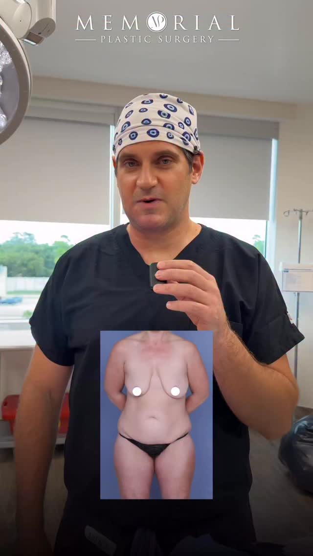Great on-table result from this past week 🔥👌🏼

Excess skin & lost volume after major weight loss is incredibly common and surgery is often the final step in the journey. 

I performed a Circumferential Body Lift, Lipo360, Breast Lift w/ Implants & Fat Grafting to breasts. 
(Pre-Sx Wt: 169.6 Ht: 5’4 BMI: 29.1)

She looks great and I’m very happy for her! 👍🏼

📍 @memorialplasticsurgery | #houston #plasticsurgeon