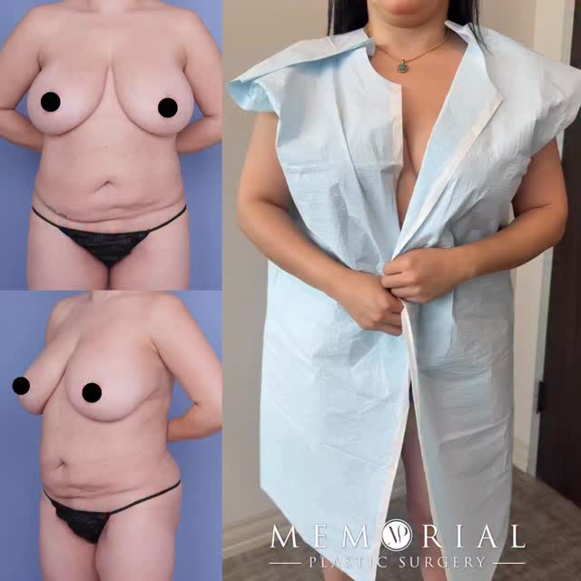 She had liposuction at another practice in 2023 and after losing 40lbs she was left with excess skin that she wanted addressed. 

That was her main concern coming in. Along with her breasts, she wanted them smaller but didn’t want to lose the volume and projection she had.

3.5 months post-op and she looks great! 👍🏼👍🏼

Procedures: Ext. Tummy Tuck, Lipo360, Breast Reduction, BBL, J-Plasma to the back & Thigh Lipo

📍 @memorialplasticsurgery | #houston #plasticsurgeon #drvasilakis