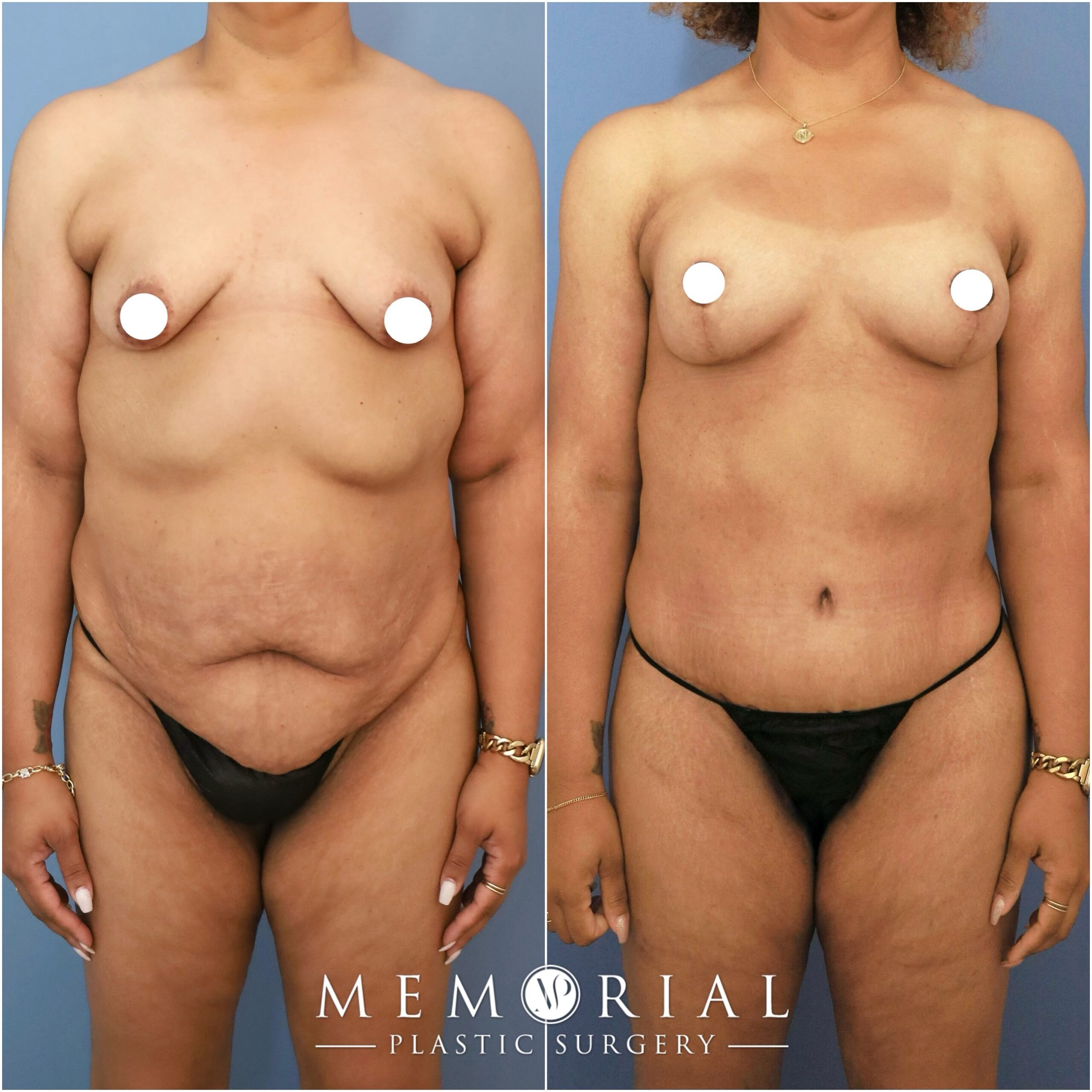 Following an 85-lbs weight loss and 3 children, my beautiful patient was ready for her transformation. 

She was healthy, active and at her goal weight, and we addressed all areas that she was concerned about: abdomen, back, breasts, and arms, in order to complete her journey.👌🏼

Procedures (performed in 2 stages): Circumferential Lower Body Lift, Lipo 360, Breast Lift w/ implants (Aug-Pexy, 295cc) & Arm Lift (Brachioplasty).

📍 @memorialplasticsurgery | #houston #drvasilakis #weightloss #majorweightloss #mommymakeover