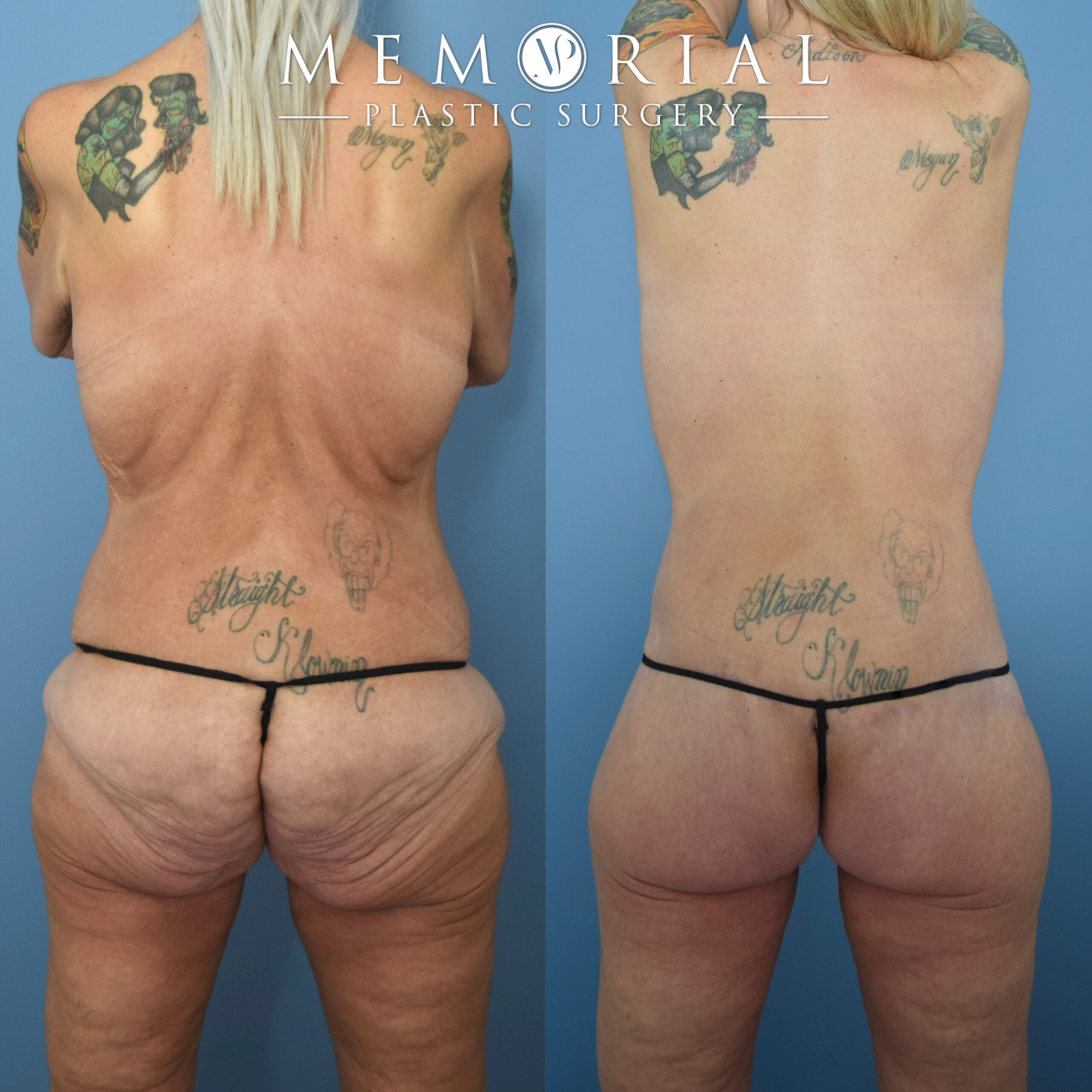 The power of Body Lift 💪🏽

My beautiful patient lost 120 lbs following gastric bypass surgery. She did a great job at maintaining her goal weight and was ready for her body contouring surgery.

This is a great example of the dramatic effect that the posterior body lift has in tightening the entire torso. The scar can be easily hidden below thin underwear and swimwear 👏🏼👏🏼

📍 @memorialplasticsurgery | #drvasilakis #houstonplasticsurgery #bodylift #majorweightloss #bodylift