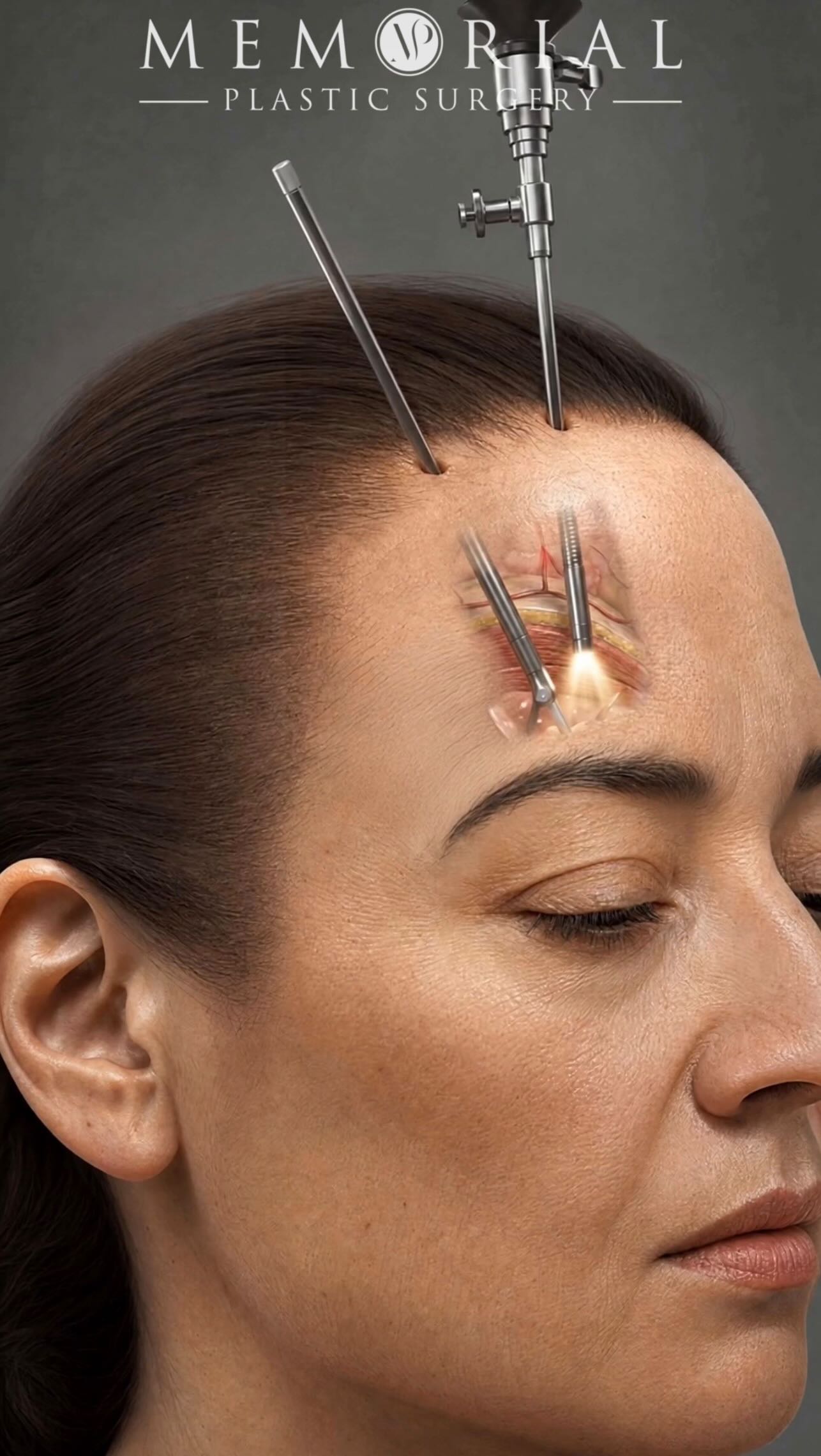 The “surprised look” brow lift hasn’t existed for a long time ☝🏻
The modern endoscopic version? Small, hidden incisions. A natural vector that contours more than simply “lifting.” And all without that frozen appearance.
High impact. Hidden scars. Minimal downtime.
Questions below 💬
📍 @memorialplasticsurgery | #Houston