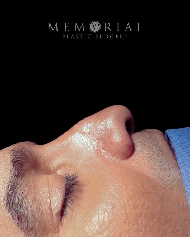 Straight off the table. 👃🏻
This patient never loved his nose — not as a teenager, not decades later. He didn’t want a dramatic change. He just wanted his face to feel balanced.
The goal wasn’t a new nose. It was the right nose for his face.
Still on the table here, so swelling is on board — but the balance and proportion are already there.
Questions below 💬
📍 @memorialplasticsurgery | #Houston