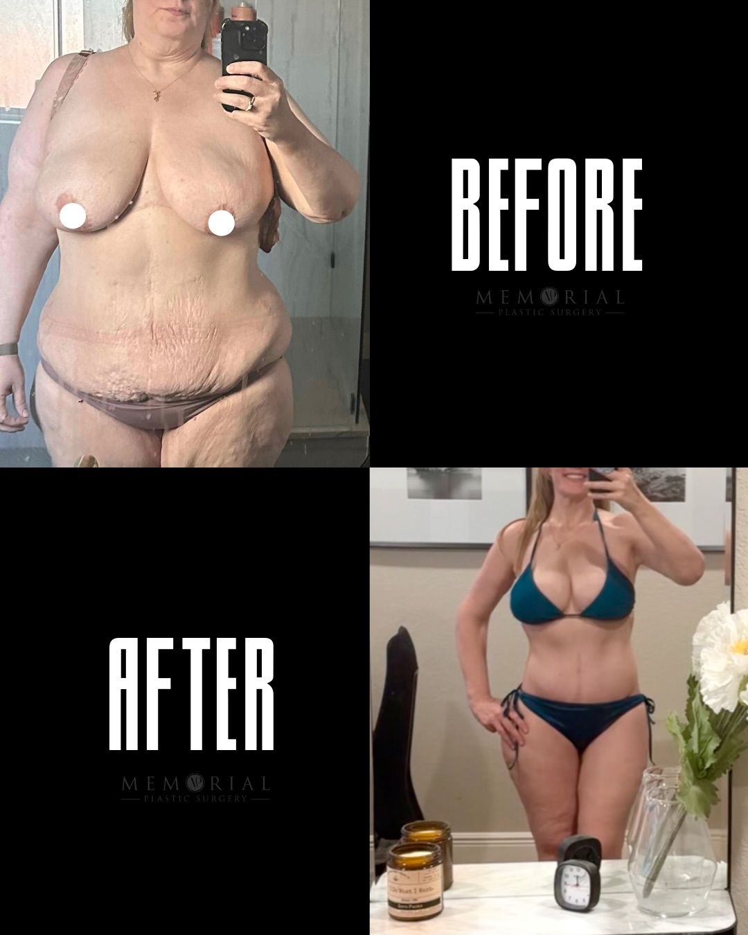 This patient sent me new footage of her transformation, and I had to share it. 🙌🏼

100 lb weight loss. 3 stages of surgery. And a smile in this video that says more than any caption could.

Stage 1: Breast Lift and Arm Lift
Stage 2: Circumferential Body Lift & Lipo 360
Stage 3: Thigh Lift, BBL & Round 2 Lipo 360 (& creation of a new belly button, as her own was lost during emergency abdominal surgery over a decade ago)

(Facial rejuvenation surgery was performed at a different practice)

So proud of her then. Even more proud of her now. 🙏🏼

📍 @memorialplasticsurgery | #Houston #weightlossjourney #bodytransformation #plasticsurgery