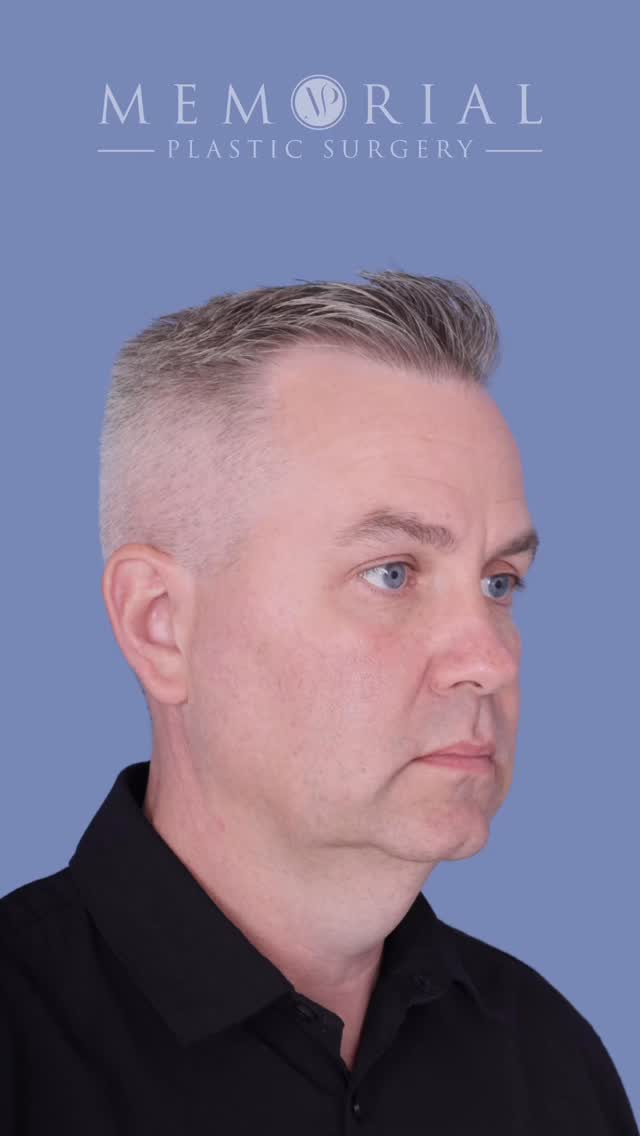 One month out, and already showing real progress.
This wonderful 45-year-old gentleman came in after doing the hard work. He lost weight, but felt his jawline and neckline aged him more than the weight did. His jawline and neck line didn’t match how he good he felt day to day.
Still some swelling here, especially behind the ears. Incisions are still settling as well. It’s early. It’s all normal healing. But the refined structure is already starting to show through.
Most importantly, he still looks like himself. Just sharper around the edges.
It’s only going to get better. We’re only just beginning.
Procedure(s) performed:
🔹 Deep plane facelift
🔹 Deep structural neck lift
As always, questions below 💬
📍 @memorialplasticsurgery | #houston