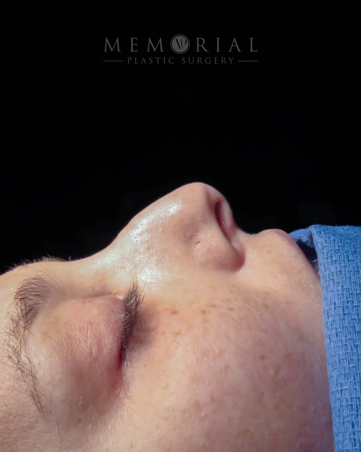 Fresh off the table. 👃🏻
She came in bothered by the bump on her profile. We addressed that and refined her tip to complement the new structure. This creates a nose that fits her face so well.
So we built a comprehensive plan, and this is what we’re looking at straight off the table.
Still swollen. Still early. But we’re already thrilled for her.
📍 @memorialplasticsurgery | #Houston
As always, questions below 💬