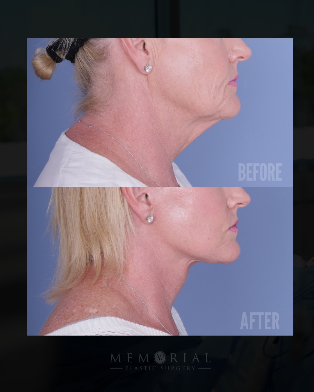 Her son’s wedding was coming up, and she wanted to look like the best version of herself for it. She wanted to show up not only for her family, but just as importantly for herself. We tailored a meticulous plan to lift fallen structures and bring to the outside how she felt on the inside.
This is what happened. 👌🏻
Procedure(s) performed:
🔹 Preservation deep plane facelift
🔹 Deep structural neck lift
🔹 Endoscopic brow lift
🔹 Lower lid pinch blepharoplasty
🔹 Full face CO2 laser resurfacing
Questions below 💬
📍 @memorialplasticsurgery | #Houston