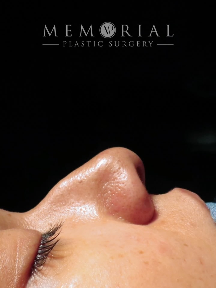 Fresh off the table. 👃🏻

This wonderful 32-year-old came in with something she’d been living with for a while — a dorsal hump that bothered her, a tip that needed refinement, and a deviated septum that had been affecting her breathing ever since she had an accident a year ago.

One procedure. Two problems solved.

The cosmetic and the functional, addressed together. A nose that looks better and works better.

On the table, so still early. But already exactly where we want to be.

Procedure(s) performed:

🔹 Rhinoplasty
🔹 Septoplasty

Questions below 💬

📍 @memorialplasticsurgery | #Houston