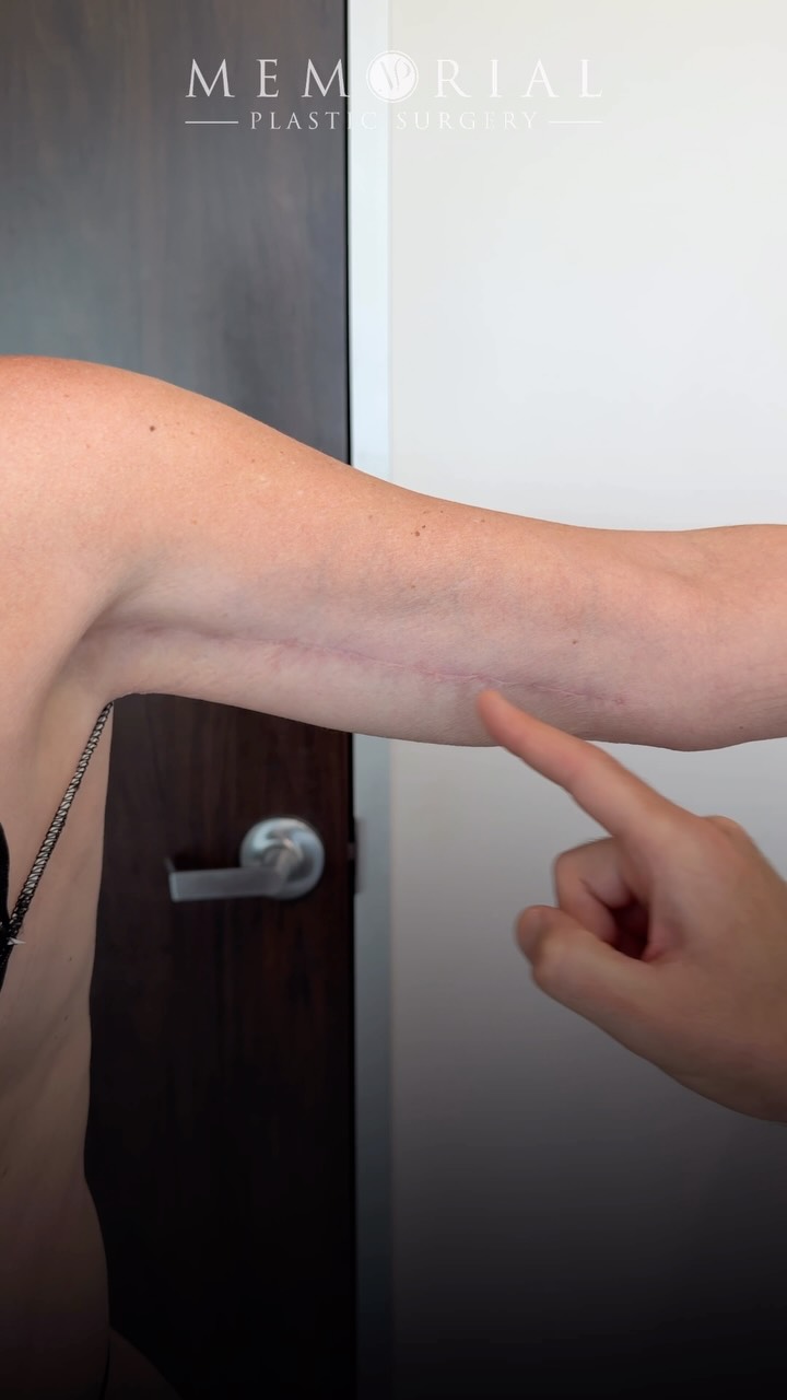The scar is the #1 reason patients hesitate before an arm lift. So let’s talk about it. ☝🏻

At 7 months — a thin, flat line on the inner arm. Doesn’t show from the front. Doesn’t show from behind. Positioned exactly where it needs to be.
Placement is everything. And with the right technique and good scar care, this is where you end up.

Still fading. 🙏🏼

📍 @memorialplasticsurgery | #armlift #brachioplasty #scarhealing #bodycontouring houstonplasticsurgeon