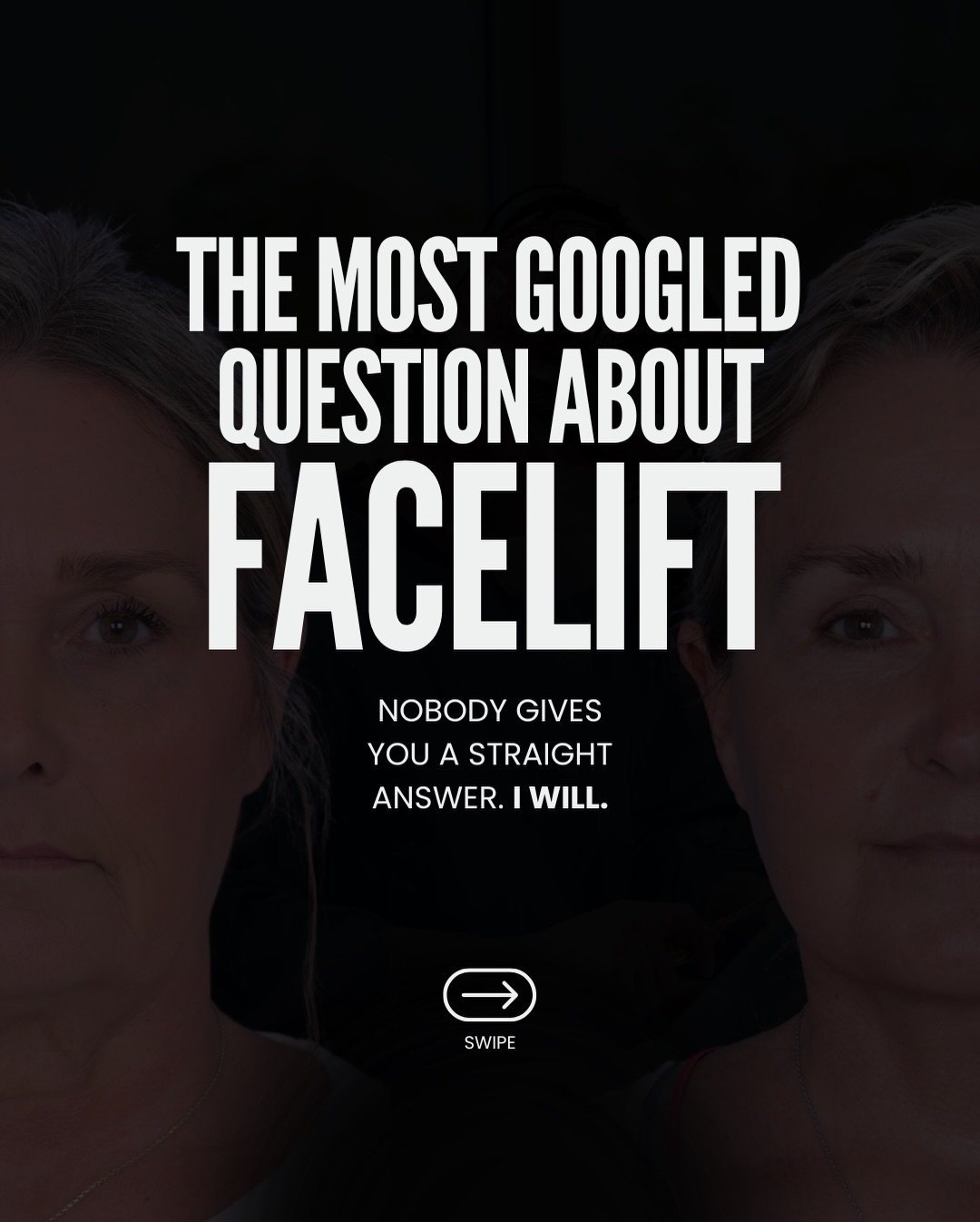 Believe me — I know there are a lot of you out there Googling this at midnight.

Saving posts. Reading forums. Looking at results trying to figure out what went wrong on someone else’s face so it doesn’t happen to yours.

And the good news? A deep plane facelift — done right — gives you the most natural looking result possible. Not younger by a specific number of years. Not different. Just you, but the best you.

The answer you’re looking for isn’t on Google. It’s in the consultation.

📍 @memorialplasticsurgery 
Questions below 💬