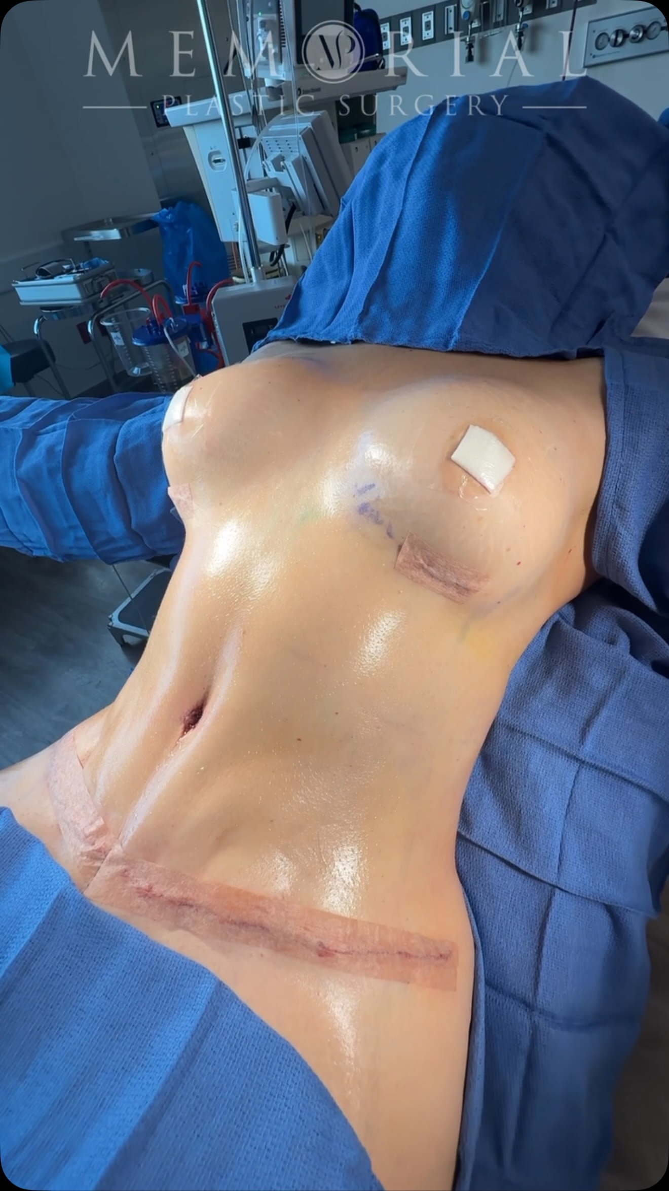 My patient came in wanting a flatter abdomen, more definition, and fuller breasts — with a result that still looked like her. 🔥
On-table result after a full surgical plan addressing her abdomen, flanks, hips, thighs, arms, and breasts — all in one stage.
Procedures: Drainless Tummy Tuck, Lipo 360, Fat Grafting to the Hips & Hybrid Breast Augmentation using 320 cc Implants and Fat Grafting to the Breasts.
(Pre-Sx Wt: 148 Ht: 5’7 BMI: 23.2)
📍 @memorialplasticsurgery | #tummytuck #breastaugmentation #bodycontouring #houstonplasticsurgeon