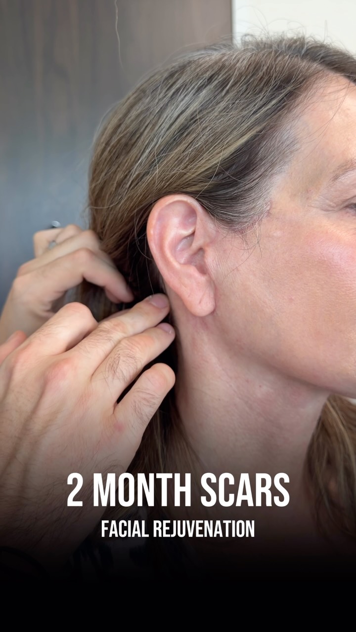 The incision nobody can find. 🤫

A facelift incision is long — but it’s designed to disappear.

It follows the natural contours of the ear, tucks behind the hairline, and breaks into transition zones that heal invisibly. 

The goal is simple: wear your hair up, go to the gym, live your life — and nobody ever knows.

Questions, comments, curiosities — all below 💬

📍 @memorialplasticsurgery | #houston