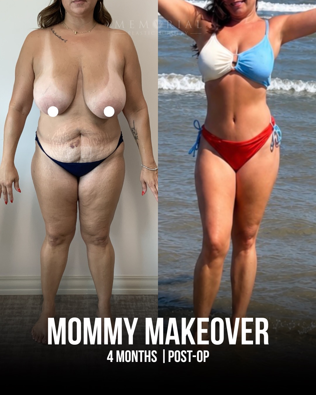 Her story on the next slide is a true testament to the power of a Mommy Makeover.
My patient became a mom at 18. By age 24 she had three boys. For 27 years, everyone else came first.
And at 45, she decided it was her turn. 🙏🏼
She is currently 4 months post-op and she’s on a beach, in a bikini, feeling like herself again.
I’m so happy for her and grateful to have been a part of her journey 😊
Procedures: Extended Tummy Tuck, Lipo 360, Fat Grafting to Hips & Breast Reduction.
📍 @memorialplasticsurgery | #mommymakeover #bodycontouring #breastlift #houstonplasticsurgeon
