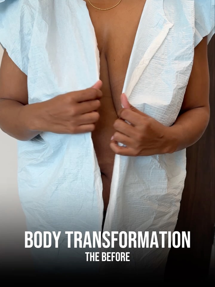 110 pounds lost through diet, exercise, and GLP-1 medication. Stable at her goal weight for over six months. She did everything right. 💪
Her concerns were what I see most often after significant weight loss — circumferential skin laxity, deflated breasts, and a silhouette that didn’t reflect the work she had already put in.
This is her on-table result after addressing all of it in one stage. 🔥
Procedures: Circumferential Body Lift, Lipo 360, Bilateral Breast Lift.
(Pre Sx Wt: 170 lbs Ht: 5’4 BMI: 29.2)
📍 @memorialplasticsurgery | #bodylift #breastlift #bodycontouring #weightloss #houstonplasticsurgeon