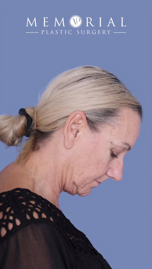 64 years young — and the mirror finally agrees.

Jowling along the jawline, heaviness in the lids, a neckline that had quietly lost its sharpness. We built a plan around all of it.

This is what a tailored comprehensive rejuvenation looks like.

Procedure(s) performed:

🔹 Preservation Deep plane facelift 
🔹 Deep neck lift
🔹 Upper lid blepharoplasty
🔹 Lower lid pinch blepharoplasty

Questions below 💬