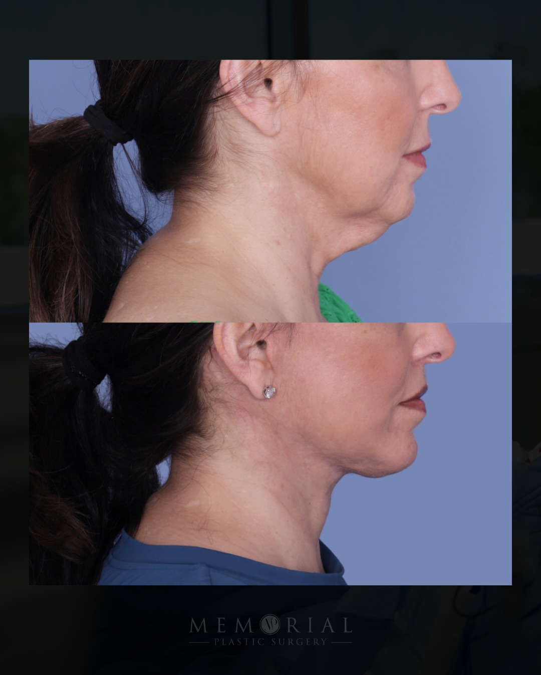 This wonderful 57-year-old came in bothered by laxity along the jawline and neckline. The things that happen quietly over time until one day you just notice it.

This is what happens when a tailored plan and meticulous execution address all of it. The jawline is sharper. The cervicomental angle is back. The buccal fat reduction and lip lift refined the midface in a way that brings everything into balance.

Procedure(s) performed:

🔹 Preservation deep plane facelift
🔹 Deep neck lift 
🔹 Temporal brow lift 
🔹 Deep lip lift
🔹 Buccal fat reduction 
🔹 Chin augmentation 

Questions below 💬