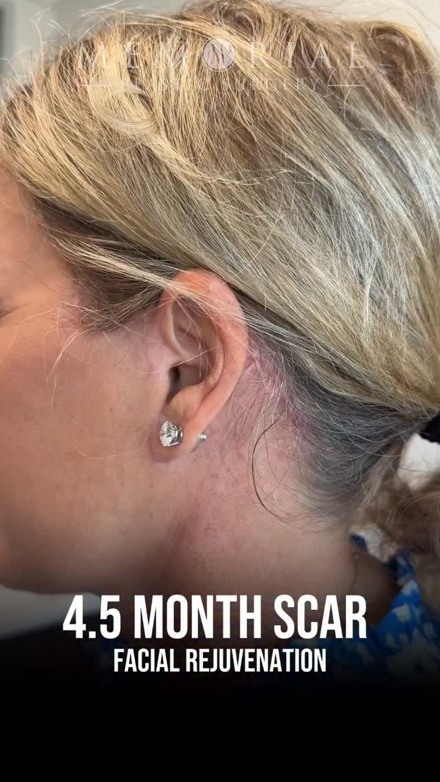 4.5 months post-op. Still healing — and already almost invisible.
Every incision is placed and closed with one goal: that nobody ever knows it was there. Not in a ponytail. Not at the gym. Not at the hair salon.
And it only gets better from here.
📍 @memorialplasticsurgery | #Houston
Questions below 💬