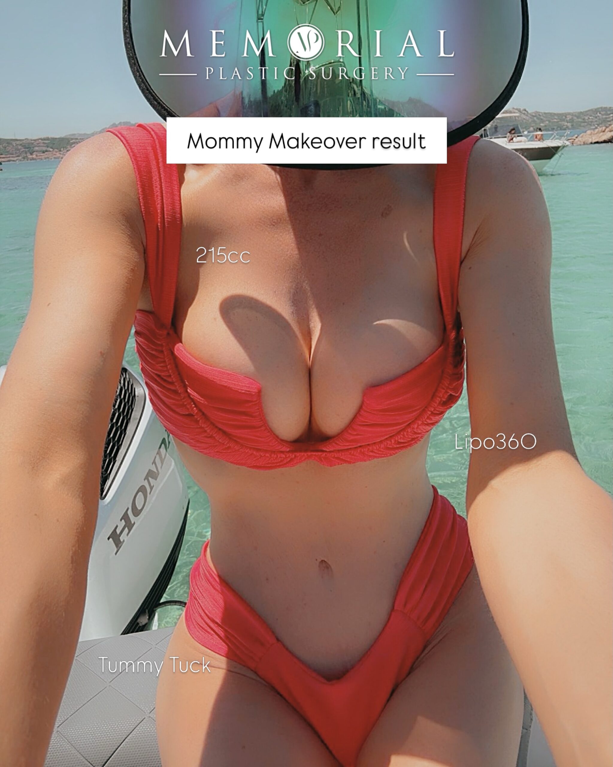 Beautiful Mommy Makeover result for my amazing patient thriving on her vacation in Italy. She underwent a Tummy Tuck, Lipo 360 & Breast Augmentation using 215 cc Motiva Implants.🔝
The goal is to achieve a natural contour, thin and tight abdomen, normal-looking belly button, and appropriately placed scars in order to be able to wear thin underwear and swimwear.
She has done a great job staying active and maintaining her results👏🏼👏🏼 She looks fantastic and I am very proud and happy for her! 😊
📍 @memorialplasticsurgery | #houston #mommymakeover #tummytuck #drvasilakis #breastaugmentation