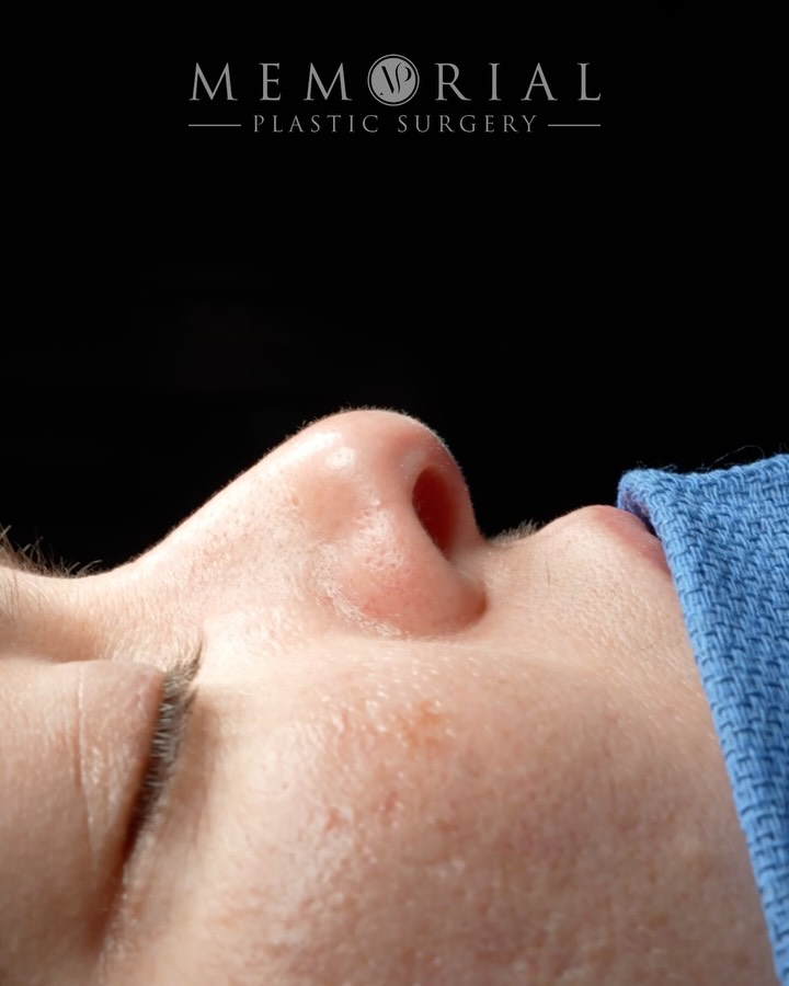 Fresh off the table. 👃🏻
She came in bothered by a dorsal hump that rounded out the profile and made the nose appear shorter than it is. Low projection, rotation, and a tip that lacked definition.
We addressed all of it. Projection, rotation, tip refinement, and the hump — building a nose that fits her face the way it should have all along.
Still swollen. Still early. But already exactly where we want to be.
Procedure(s) performed:
🔹 Rhinoplasty
🔹 Septoplasty
📍 @memorialplasticsurgery | #Houston
Questions below 💬