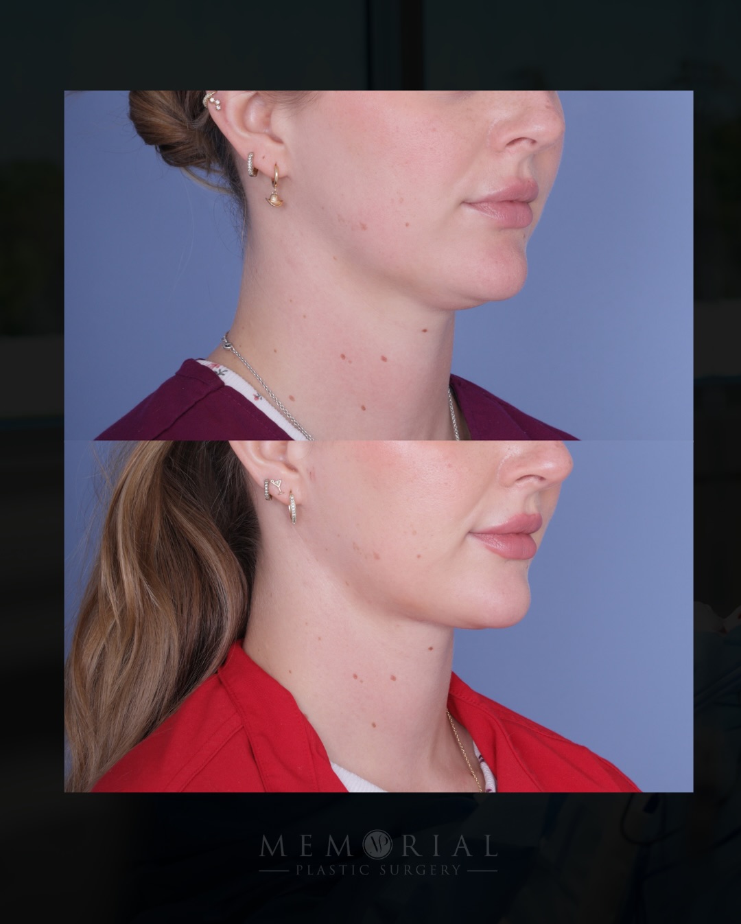 2.5 months out — and the shortest, easiest recovery.
She came in with one specific concern: fullness under the chin that wasn’t going anywhere no matter how hard she worked for it. That’s anatomy, not effort.
Too young to be a good candidate for a neck lift, we opted for a little submental liposuction to clean things up and accentuate her jawline and neckline a little more. And we are thrilled with these results just a couple months out.
Procedure(s) performed:
🔹 Submental liposuction
Questions below 💬