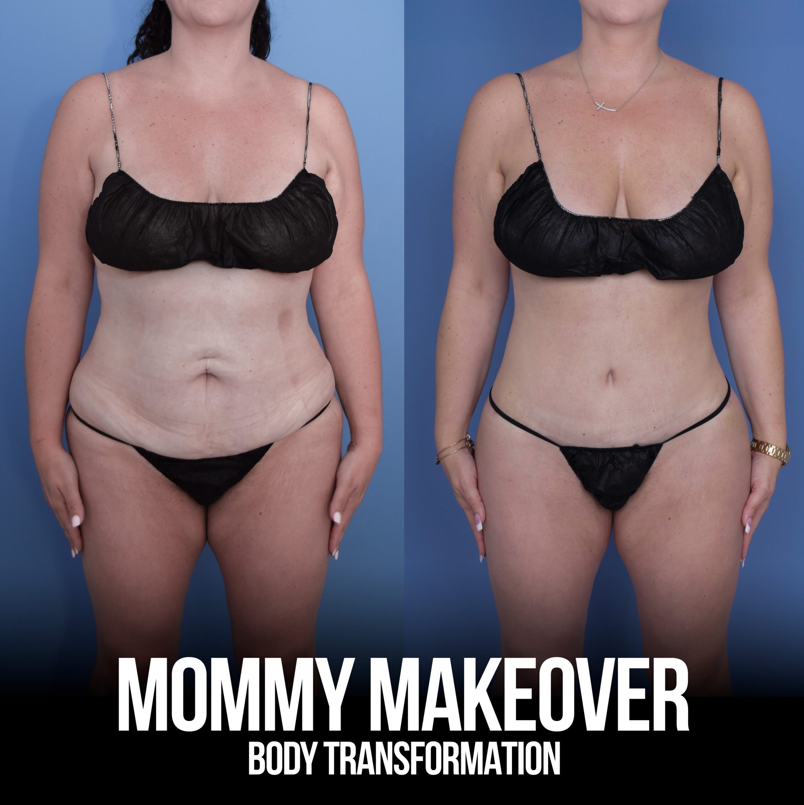 Circumferential Body Lift result. This surgery is combined with liposuction and includes a tummy tuck to achieve circumferential tightening of the abdomen, flanks, lower back and buttocks. The goal is a natural contour, normal-looking belly button and scars that can be hidden below thin underwear and swimwear.👌🏼🙏🏼
📍 @memorialplasticsurgery | #houston #mommymakeover #bodylift #beforeandafter #plasticsurgery