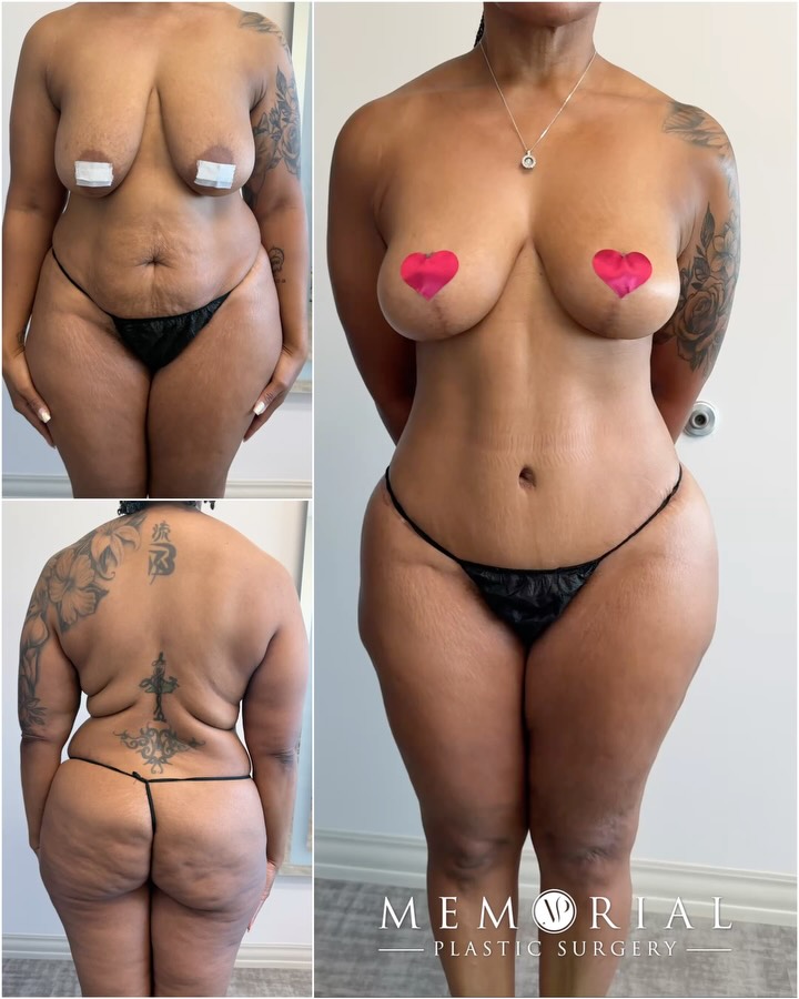 At 49, she made a decision for herself — to feel confident in her own skin ☺️🙌🏼
After pregnancy and weight loss, her body had changed in ways that no amount of diet or exercise was going to fix.
One surgery, mommy makeover, and everything was addressed. Her breasts and circumferential body are tighter, her entire contour thinner and enhanced, the belly button is normal-looking, and all the scars are appropriately positioned to be hidden below thin underwear and swimwear. She has done an amazing job healing and recovering, and I am very happy for her! 🙏😊
Procedures: Circumferential Lower Body Lift, Breast Lift, Lipo360, BBL & J-Plasma to back for skin tightening
📍 @memorialplasticsurgery | #mommymakeover #transformation #bodylift #bodycontouring #houstonplasticsurgeon