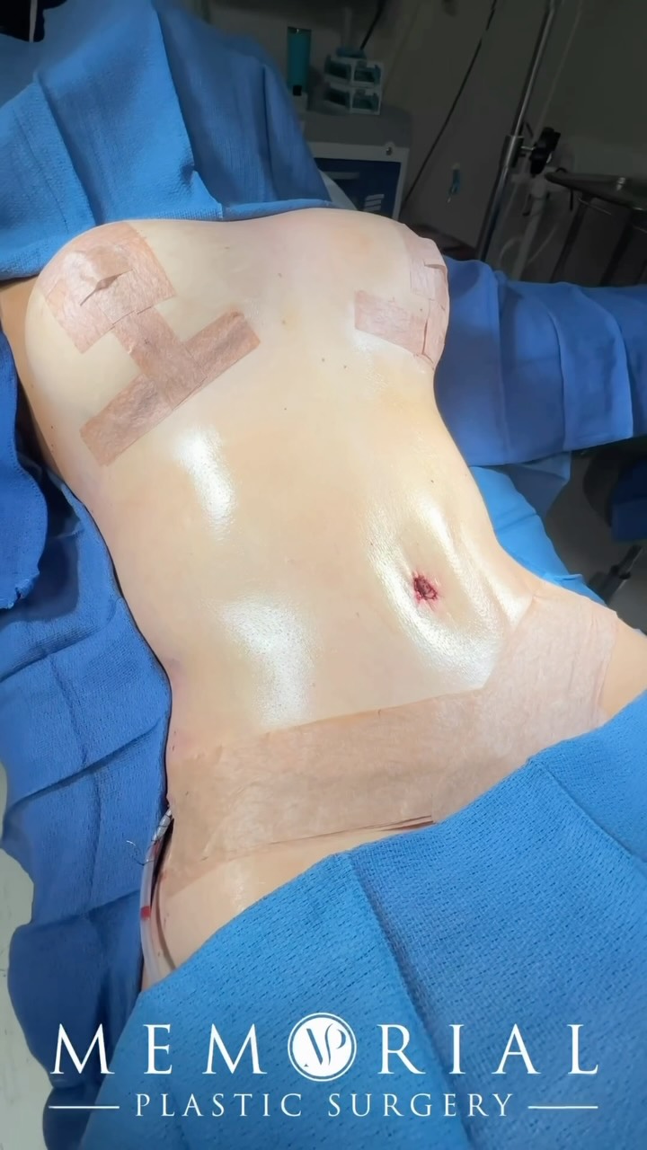On-table result after a full transformation. 🙏🏼

She came in with clear goals and we built a surgical plan around every single one of them. So happy with how everything came together for her.

Procedures: Circumferential Body Lift, Breast Lift w/ Implants (295 cc Full Profile), BBL, Lipo to Flanks & Fat Grafting to Breasts 🔥

(Pre-Sx Wt: 135 lbs | Ht: 5’6 | BMI: 21.8)

📍 @memorialplasticsurgery | #Houston #Mommymakeover #plasticsurgeonhouston #beforeandafter