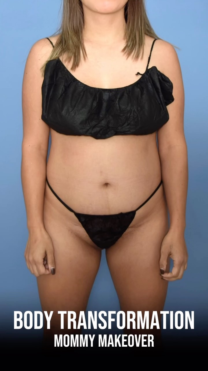 Not every transformation happens in one surgery. 🙏🏼

This patient, a mother of 3, came to me for her first stage a few years ago. Three years later, she came back to finish what we started. Two carefully planned surgeries, one final result.

Stage 1: Lipo360 + BBL

Stage 2: Extended Abdominoplasty, Lipo360, BBL, Fat Grafting to Hips & J-Plasma to Back

Some results are built over time. This is one of them. 🔥

📍 @memorialplasticsurgery | #houstonplasticsurgeon #beforeandafter