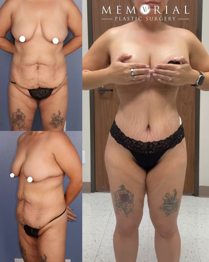 Just two weeks post-op and already looking amazing 🥰😍
After a 75lb weight loss, she decided it was time for her to take the final step to feel confident in her own skin 🫶🏼
I’m so happy for her and am excited to see her confidence continue to blossom ✨
📍 @memorialplasticsurgery | #houston #femaleplasticsurgery #beforeandafter #weightloss #mommymakeover