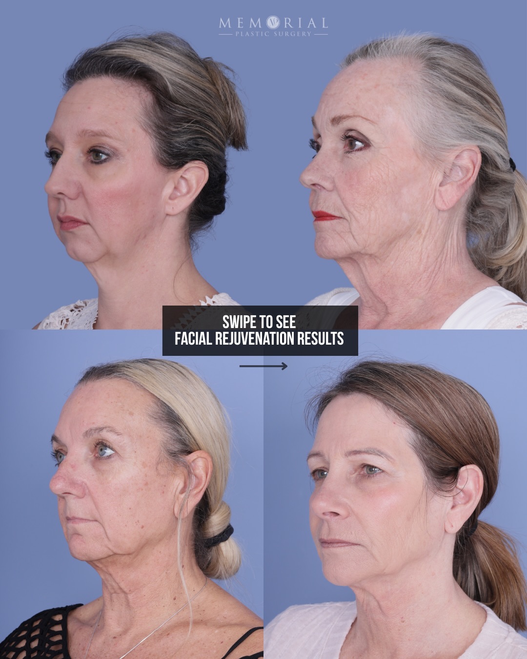 Four different faces. Four different plans. All still looking like themselves — just a younger version.
The jawline. The neckline. The structure that quietly disappears over time — and just as quietly comes back.
No two plans are the same in this room. But the result always is: still looks like you. Just the version you remember.
Questions below 💬
📍 @memorialplasticsurgery | #houstonplasticsurgeon #beforeandafter #facialrejuvenation