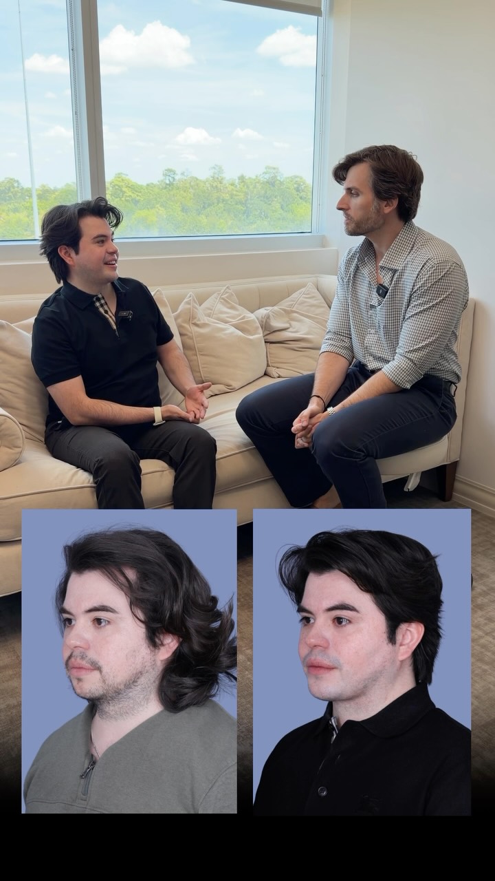 Testimonial Tuesday 🎙️
Unscripted. Unedited.
“I still look like me. Like I just lost a little bit of weight. Nothing crazy.”
2.5 months out. Still looks like himself. Just the version where his face finally matches the work he puts into everything else.
Exactly how it’s supposed to work. 🙌🏻
Procedures:
🔹 Necklift
🔹 Chin Implant
🔹 Buccal Fat Pad removal
Questions below 💬
📍 @memorialplasticsurgery | #houstonplasticsurgeon #beforeandafter